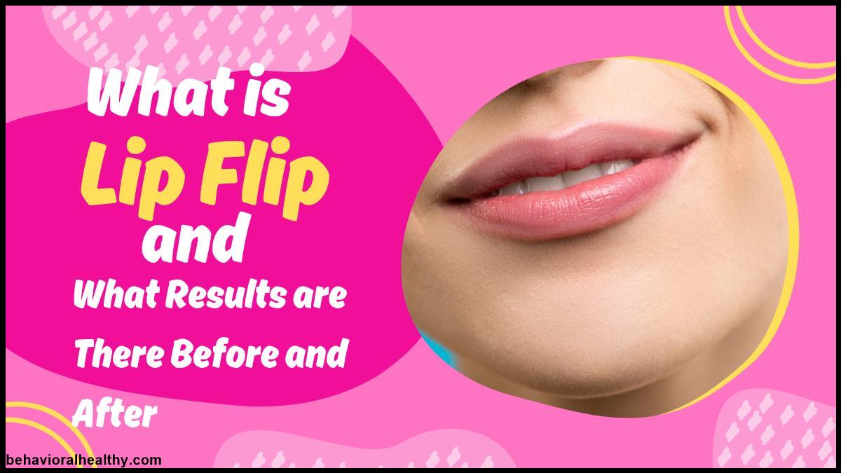 What is Lip Flip and What Results are There Before and After.jpg